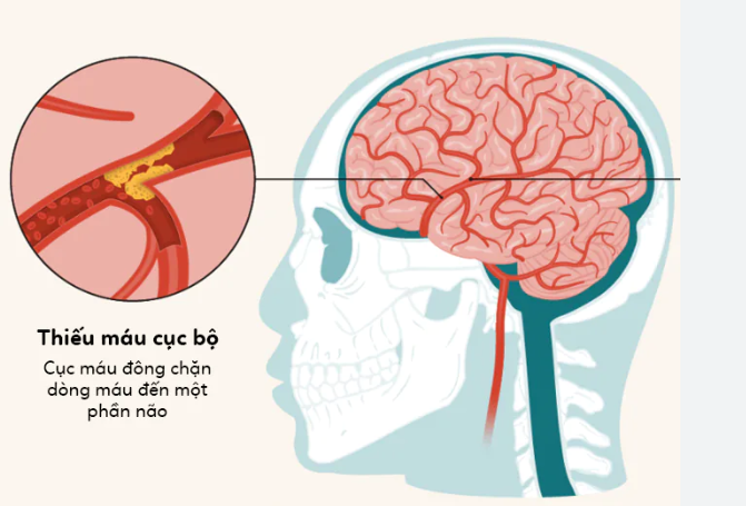 Triệu chứng thiểu máu não: Hiểm họa âm thầm ít ai ngờ tới
