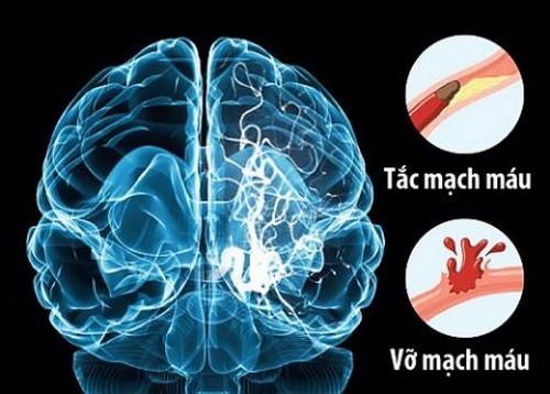 Bí quyết phòng tránh tai biến mạch máu não trong mùa hè