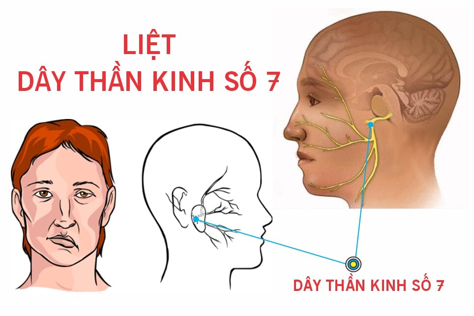 Top bệnh lý dễ nhầm lẫn với đột quỵ: Hiểu đúng để điều trị đúng, tránh nguy hiểm