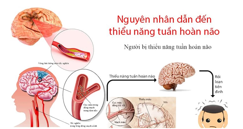 Thiểu năng tuần hoàn não có chữa được không?