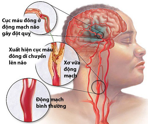 Đột quỵ thiếu máu cục bộ: Nguyên nhân và cách điều trị hiệu quả hiện nay