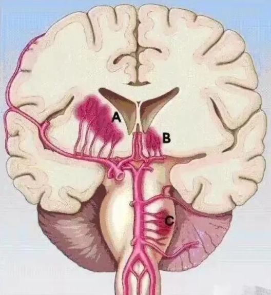 Nhồi máu não lỗ khuyết: Hiểm họa tiềm ẩn gây tử vong