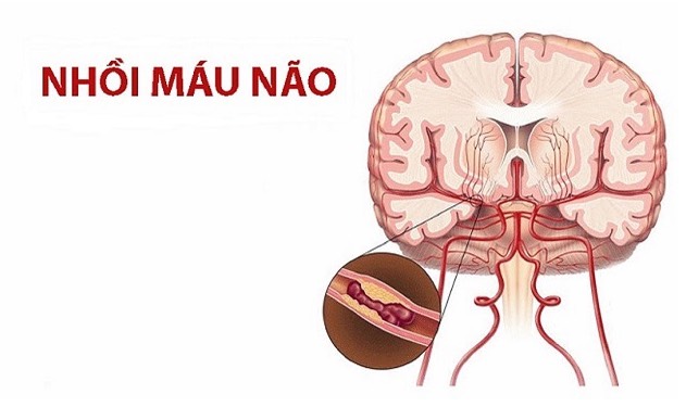 Người bị nhồi máu não sống được bao lâu? Hướng dẫn cách tăng khả năng phục hồi cho người bệnh