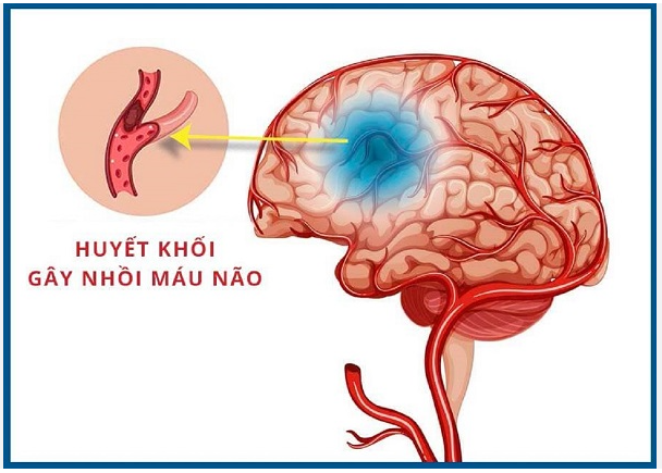 Nhồi máu não: Nguyên nhân, dấu hiệu, phương pháp chẩn đoán và điều trị