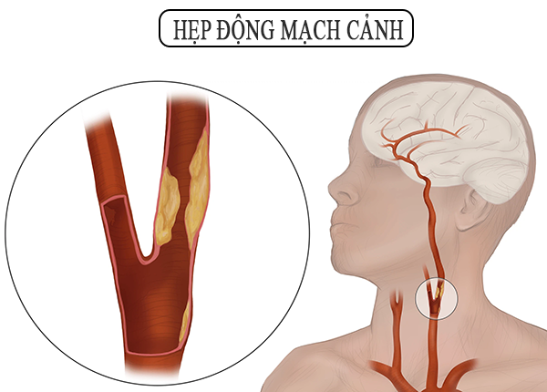 Hẹp động mạch cảnh là gì? Vì sao hẹp động mạch cảnh gây đột quỵ?