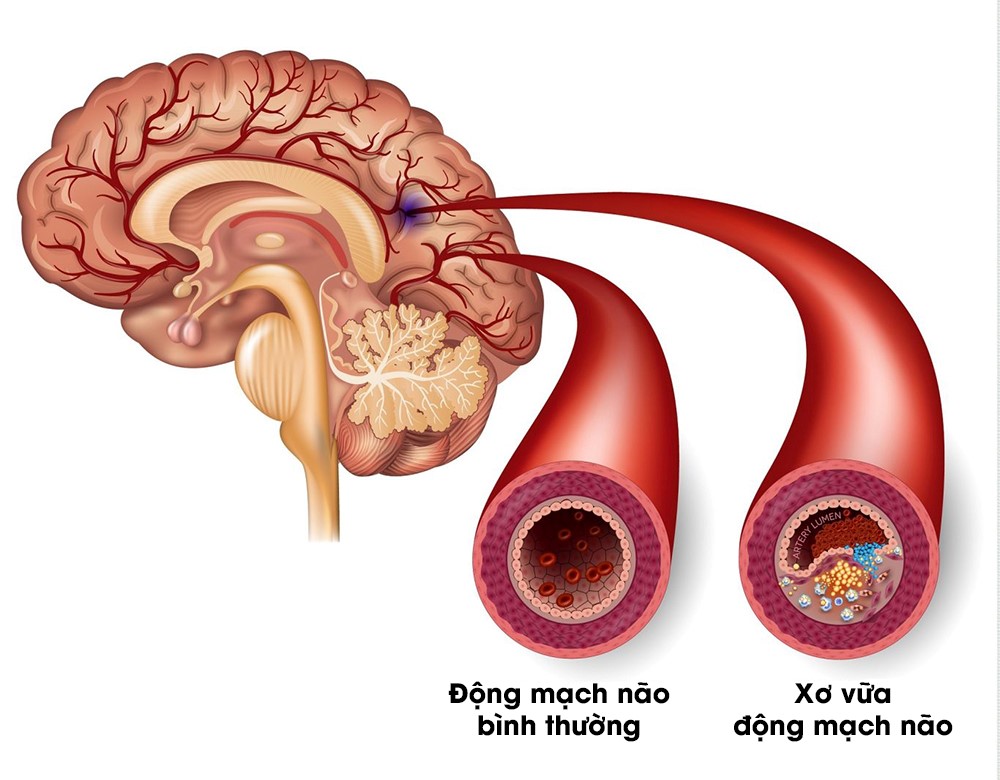 Hẹp mạch máu não: Nguyên nhân, dấu hiệu, cách điều trị hiện nay