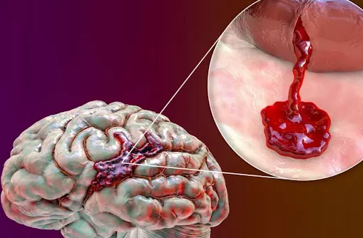 Chảy máu não: Tìm hiểu nguyên nhân và những phương pháp điều trị hiện nay
