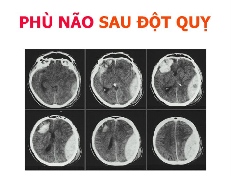 Phù não sau đột quỵ: Mức độ nguy hiểm, nguyên nhân và phương pháp điều trị