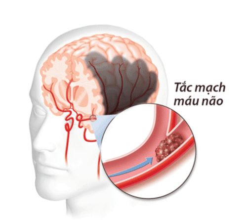 Tắc mạch máu não nên uống thuốc gì để điều trị và phòng ngừa biến chứng?