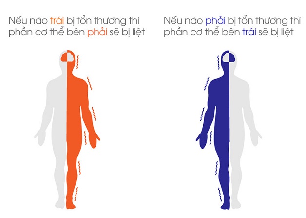 Tai biến liệt nửa người bên trái: Nguyên nhân và các biện pháp điều trị