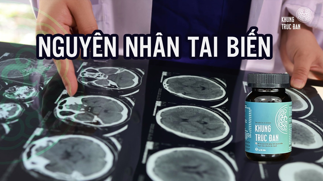 Nguyên nhân dẫn đến tai biến mạch máu não: Hiểu đúng về để phòng ngừa từ sớm